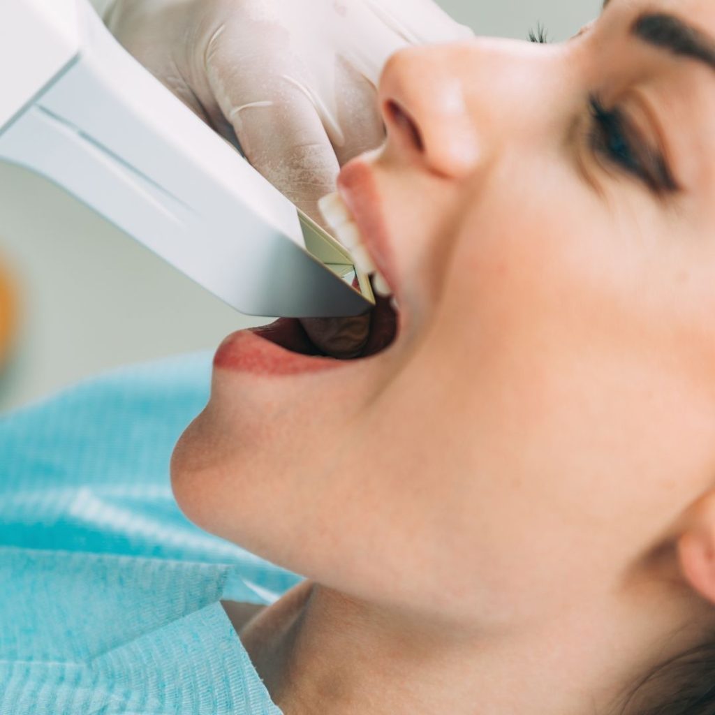 Faccette Dentali 5 faccette dentali a Novi Ligure
