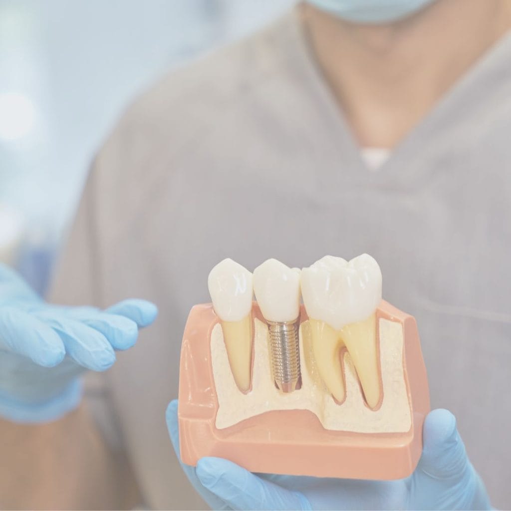 Impianto dentale a Novi Ligure - studio dentistico a Ovada