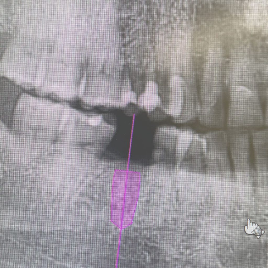 Implantologia 1 Impianto dentale a Novi Ligure - Gullo Vivaldi
