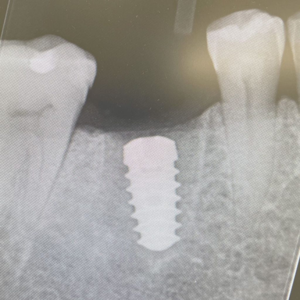 Implantologia 5 Impianto dentale a Novi Ligure - Gullo Vivaldi