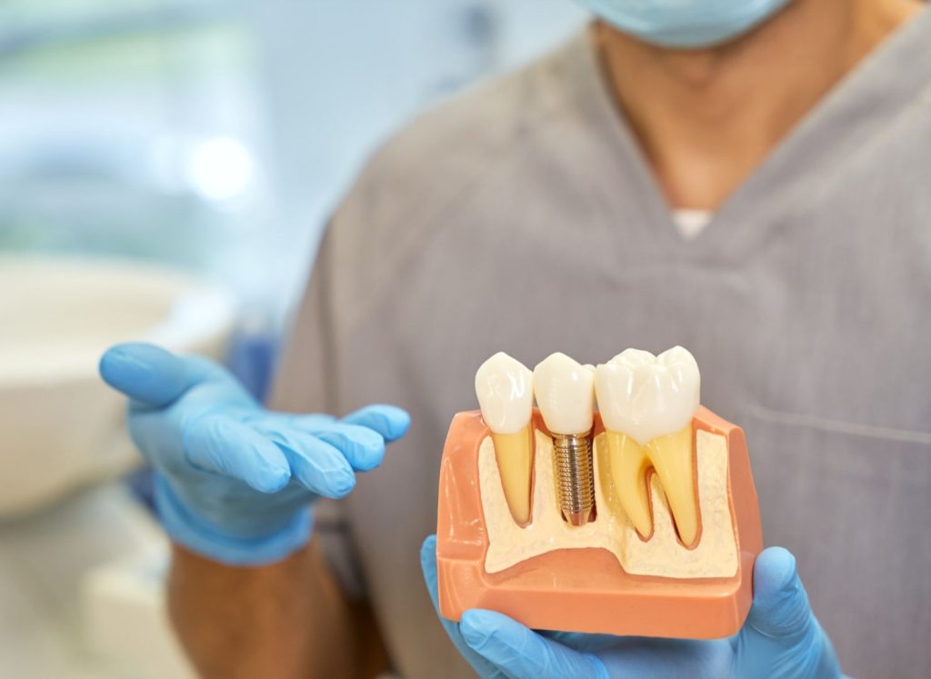 che cos'è l'implantologia dentale