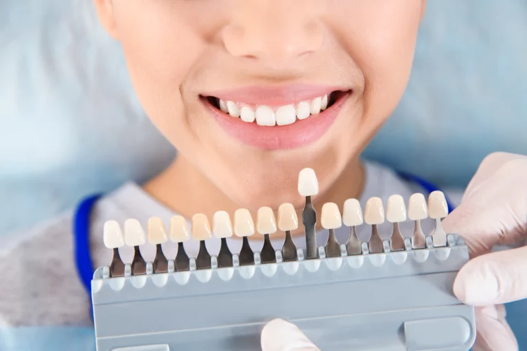 Odontoiatria estetica - Glossario odontoiatria estetica