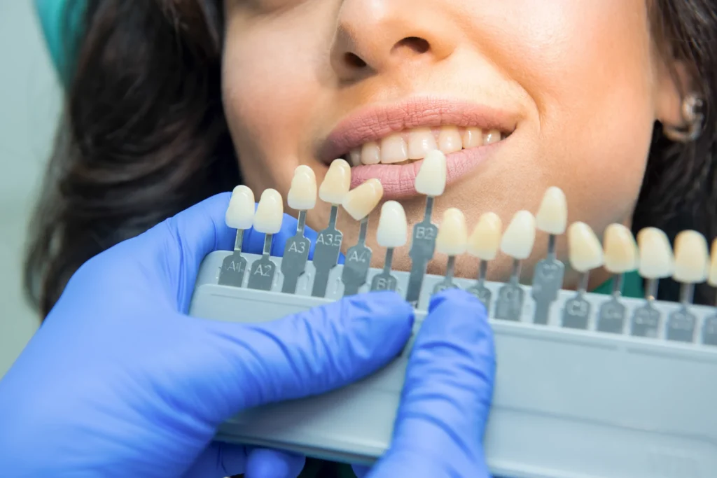 Guida completa all’odontoiatria estetica: il glossario per capire davvero i trattamenti del sorriso 2 Odontoiatria estetica