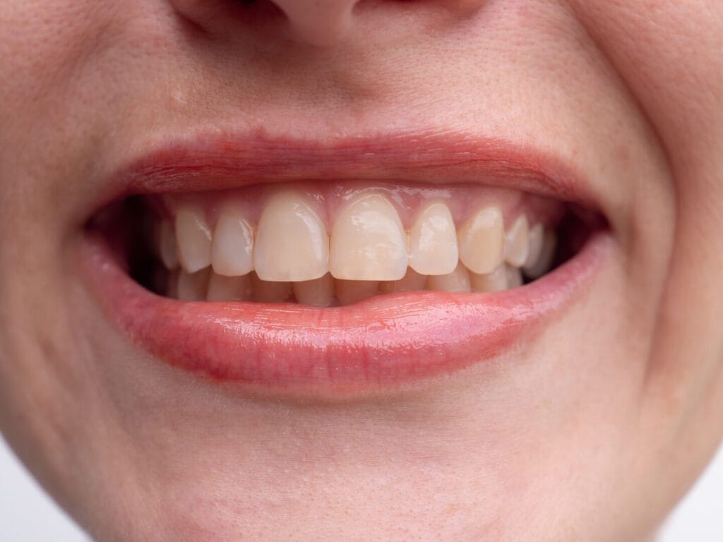Dente che si muove